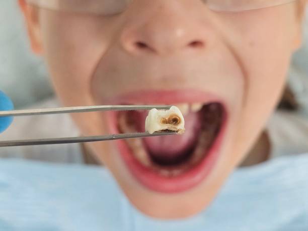 Best Broken or Cracked Tooth Emergency Dentist in Manhattan, MT